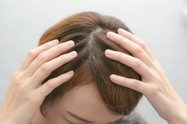 Dandruff and greasy hair on the head of a young female. Unhealthy head skin stock photo