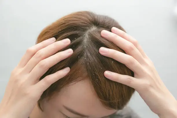 Photo of Dandruff and greasy hair on the head of a young female. Unhealthy head skin