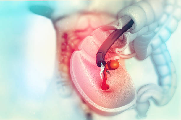 colon cancer. colonoscope in the colon. polyp removal. 3d illustration colon cancer. colonoscope in the colon. polyp removal. 3d illustration colorectal cancer photos stock pictures, royalty-free photos & images