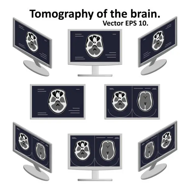 Vector illustration of Set of cross section of the brain during magnetic resonance imaging on a computer screen in isometric view. A few pictures of the image of the brain. MRI / CT scan. Vector EPS10.