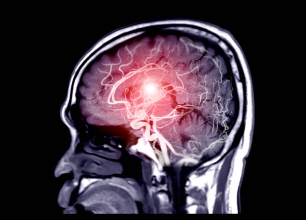 Fusion image of MRI and MRA Brain or Magnetic resonance angiography ( MRA ) . Fusion image of MRI and MRA Brain or Magnetic resonance angiography ( MRA )  of cerebral artery in the brain Sagittal view for evaluate them  stenosis  and stroke disease. infarction photos stock pictures, royalty-free photos & images