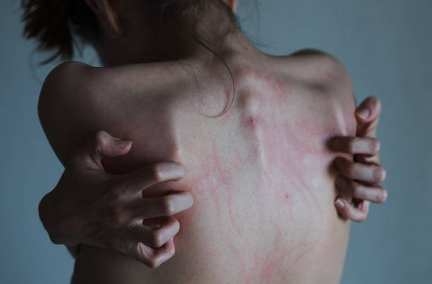 Scratches on a back Rear view - Female hand scratching her irritation back. Concept neurotic disorder, mental illness of self-harm. self mutilation pictures stock pictures, royalty-free photos & images