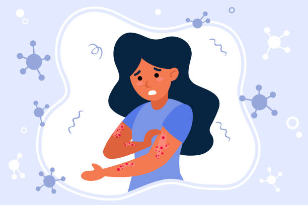 Person suffering from rush Person suffering from rush. Hives, fever, stress, chickenpox flat vector illustration. Illness, epidemics, virus concept for banner, website design or landing web page pox stock illustrations