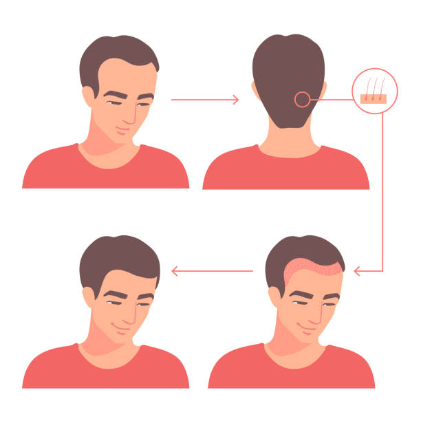 ilustrações, clipart, desenhos animados e ícones de follículos transplantados da nuca até a testa. transplante capilar. etapas de um procedimento de cirurgia plástica. um tratamento de recuo da linha do cabelo. baixando a altura de uma linha do cabelo. queda de cabelo. careca. - nape