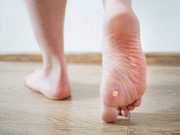 Close up photo of plantar wart on man's foot. Verruca plantaris on the heel. stock photo