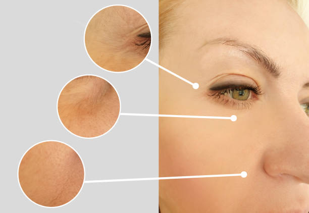 istock woman face wrinkles face before and after collage treatment 1248963764