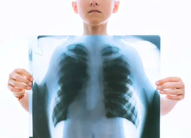 Photo of Young teenage boy holding a chest and lungs x-ray film scan in front of the body on the white backlight background. Medical diagnosis and treatment of respiratory diseases concept image.