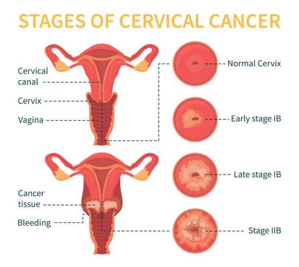 Stages of cervical cancer vector white scheme Stages of cervical cancer. Women s reproductive system. The effect of papillomavirus on the cervix. Vector infographic. diagram of female reproductive system drawings stock illustrations