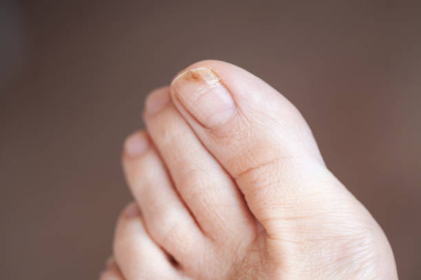 ferita l'unghia del piede femminile. - podiatrist pedicure human foot toenail foto e immagini stock