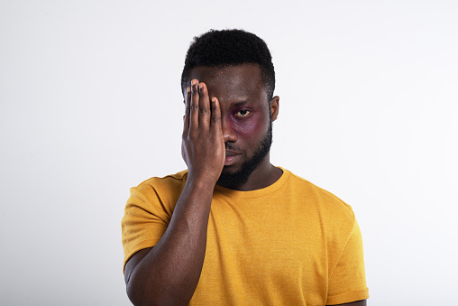 Studio portrait of an African-American young man with a bruise covering his face with palm.