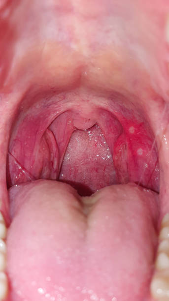 mal di gola dentro la bocca, primo piano. malattie della gola e della mucosa, arrossamento della gola e tonsille, - ugola foto e immagini stock