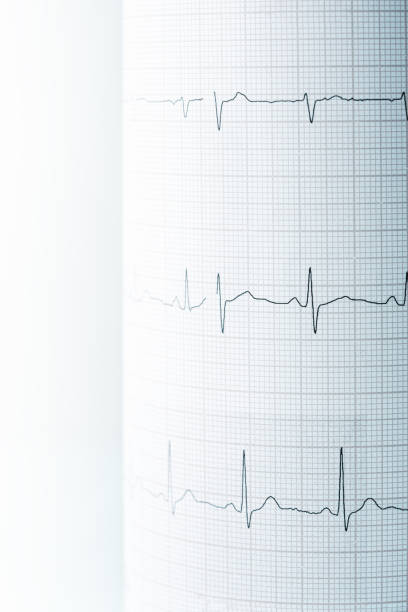 istock Heart Rhythm On Electrocardiogram Record Paper 1249451784