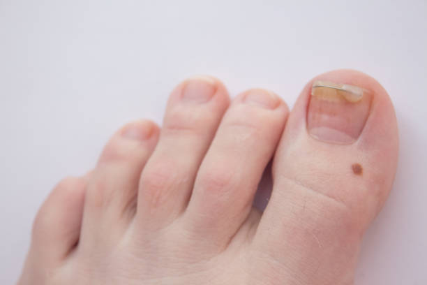 istock ingrown nail treatment. Hardware manicure. Concept body care. 1249550663