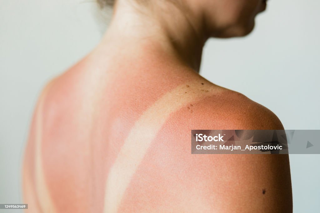 Close-up of a sunburn marks on a woman's back Sunburned Stock Photo