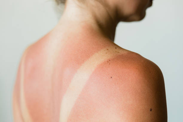 Close-up of a sunburn marks on a woman's back Close-up of a sunburn marks on a woman's back burning stock pictures, royalty-free photos & images