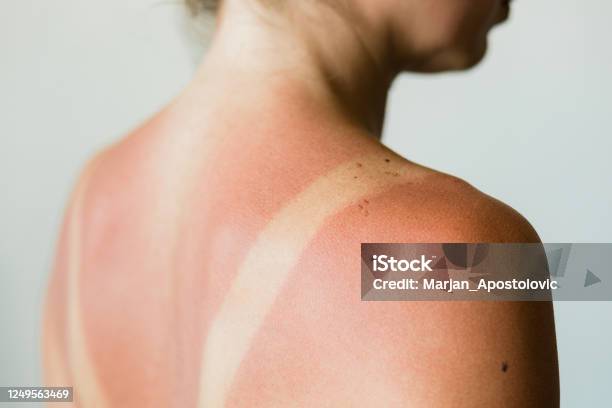 Closeup Of A Sunburn Marks On A Womans Back Stock Photo - Download Image Now - Sunburned, Skin, Sunlight