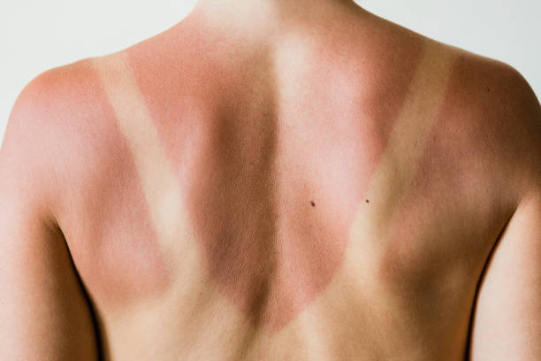 istock Close-up of a sunburn marks on a woman's back 1249563471