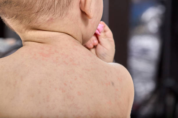 roseola rash a viral rash on the skin of a child roseola rash a viral rash on the skin of a child. roseola rash stock pictures, royalty-free photos & images