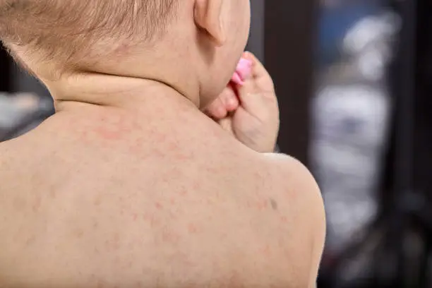 roseola rash a viral rash on the skin of a child.
