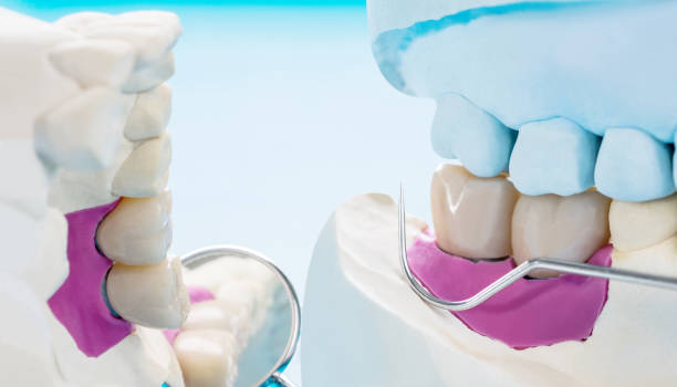 istock Implant Prosthodontics or Prosthetic 1249700018