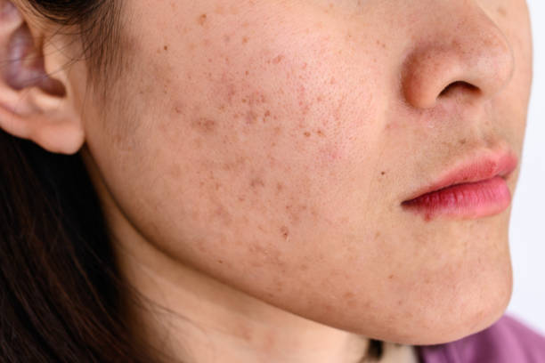 Side view close-up of woman face has variety problems on her skin (such as Acne, Pimple, Pores and Melasma etc). Conceptual of natural problem on woman skin. cheek cell stock pictures, royalty-free photos & images