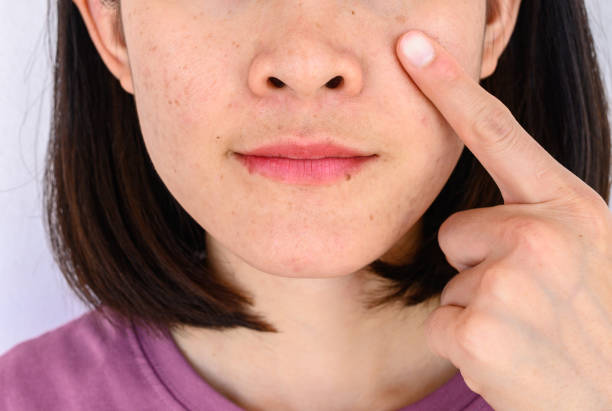 istock Close-up of woman pointing a problem on her face with variety problems on her skin (such as Acne, Pimple, Pores and Melasma etc). 1249701189