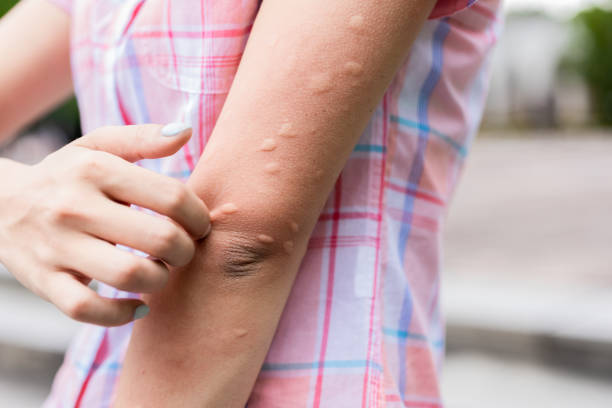 Bitten by mosquito in summer stock photo