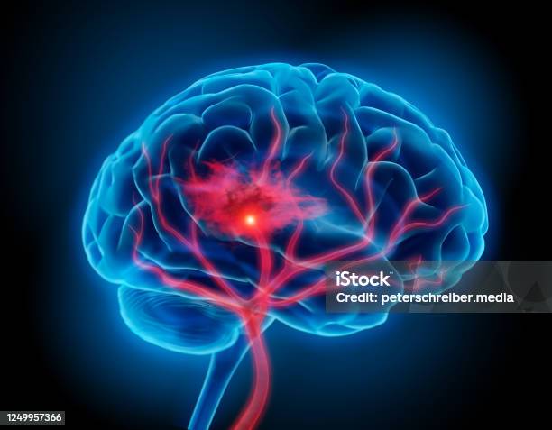 Brain Stroke Stock Photo - Download Image Now - Stroke - Illness, Healthcare And Medicine, Nerve Cell