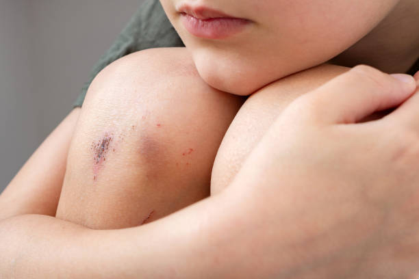 abrasiones y moretones en la rodilla de un niño triste. - abraded fotografías e imágenes de stock