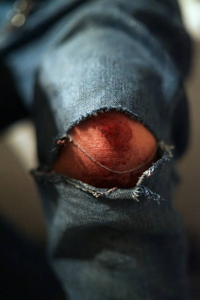 istock Scratched knee under ripped jeans after accident, open wound with blood 1250014181