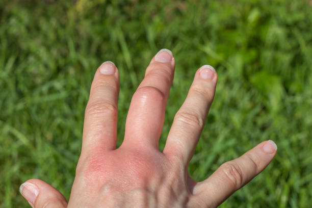 a swelling red palm after a bee bite fragment of right hand with a swollen large middle finger after a bee bite on a green background, bigger due to allergy reaction after a wasp sting, red sensation on palm, finger wounded, skin irritation stinging photos stock pictures, royalty-free photos & images