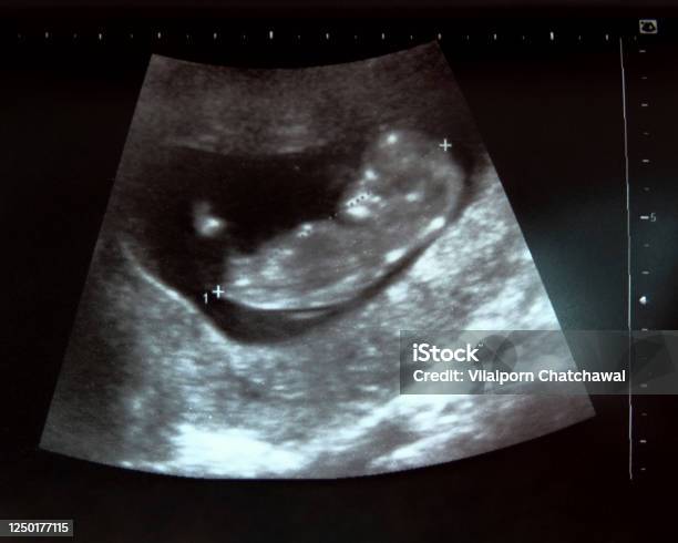 Ultrasonido Del Bebé En Mujer Embarazada A Los Tres Meses Foto de stock y  más banco de imágenes de Ecografía - iStock