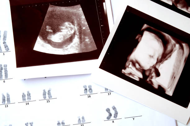 2D and 4D picture of ultrasound baby with analysis chromosomes report. 2D and 4D picture of ultrasound baby with analysis chromosomes report. chromosome photos stock pictures, royalty-free photos & images