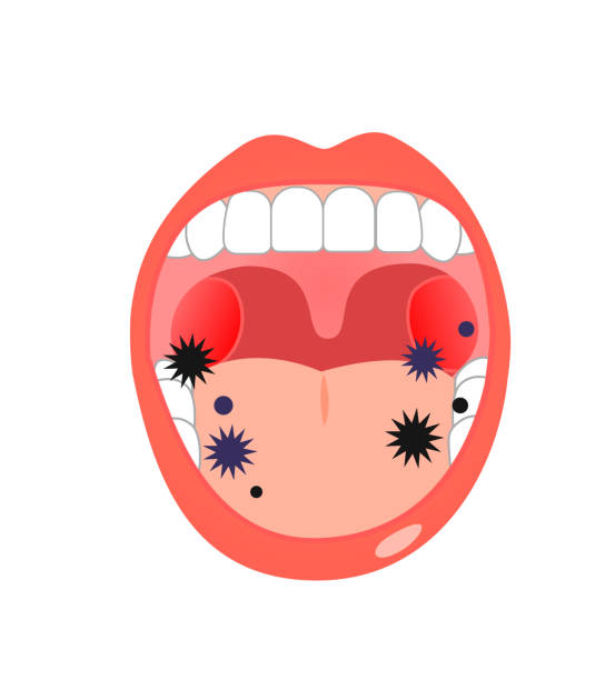 Illustration of  tonsil   throat symptoms and health Illustration of tongue symptoms and health tonsil stock illustrations