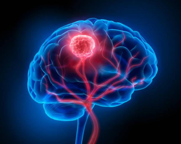 Brain Tumor Human brain with tumor - 3D illustration brain tumour stock pictures, royalty-free photos & images