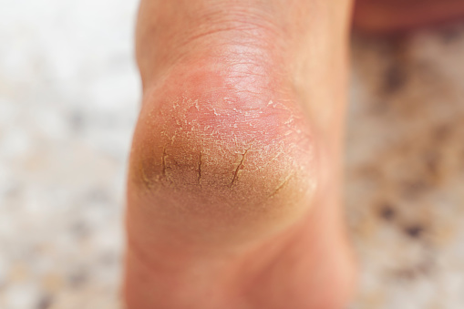 El talón del pie con mala piel está cubierto de grietas. El concepto de tratamiento médico con cremas hidratantes y también vedekure y peeling de cicatrización de heridas y dolor mientras camina dermatólogo de muestras photo