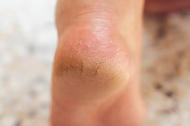 Photo of The heel of foot with bad skin is covered with cracks. The concept using medical treatment with moisturizers and also vedekure and peeling of wound healing and pain while walking swatch dermatologist