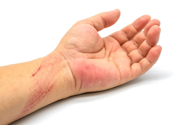 istock Bruised wound injury on arm near wrist on white background. 1250242375