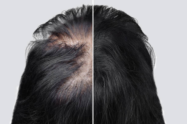 frauen glatze alopezie alopezie. haare nach der verwendung von kosmetischem pulver, um das haar zu verdicken. vorher und nachher. - glatzenbildung stock-fotos und bilder