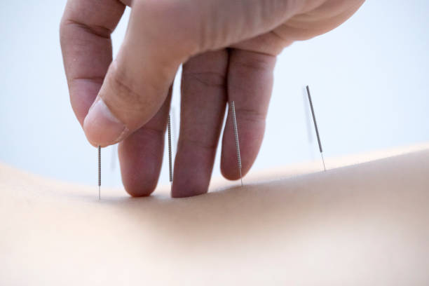 istock Acupuncture treatment close up needle 1250436640