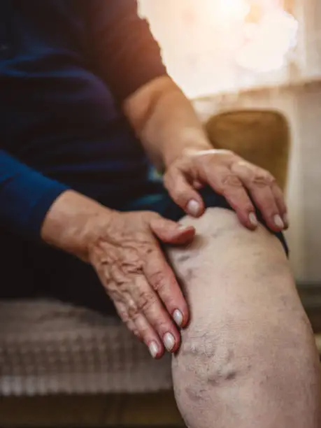 Photo of Varicose veins on the elderly woman leg