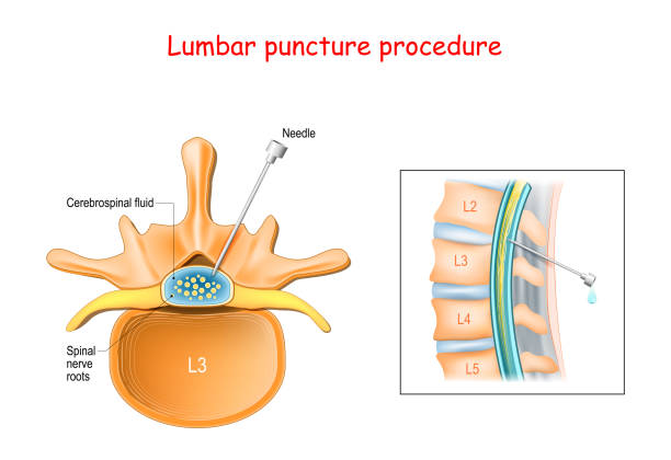 ภาพประกอบสต็อกที่เกี่ยวกับ “ขั้นตอนการเจาะเอว - puncturing”