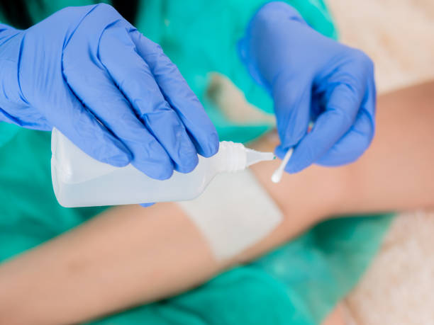 The doctor's hands in blue sterile gloves pours antiseptic on a cotton swab to treat the patient's abrasions. Close-up of a cotton swab and a bottle of antiseptic in the hands of a doctor, against the background of a wound on the patient's leg antiseptic stock pictures, royalty-free photos & images