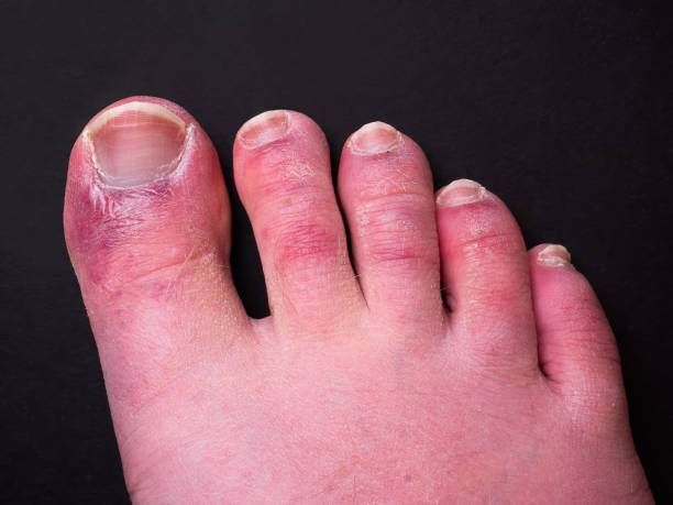 A man's toes showing what looks like a rash with red blotchy skin. A common side effect of Covid-19 often referred to as "Covid toe" Image of a man's foot captured during the coronavirus pandemic. It has been documented that a foot rash is a common side effect of having the virus. The media refers to this as 'Covid Toe'. toe stock pictures, royalty-free photos & images