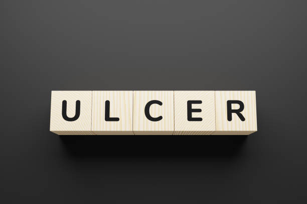 istock ULCER word on wooden blocks on gray background. 1251158810