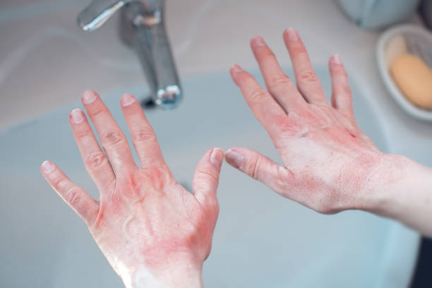 danos na pele das mãos por lavagem com sabão mãos danificadas por lavagem extensa dermatite fotos de mãos, fotos e imagens livres de direitos