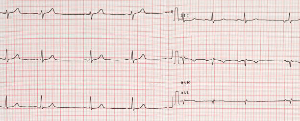 istock Electrocardiogram example of a normal 12-lead sinus rhythm 1251506200