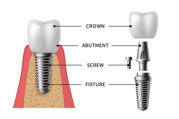 ilustraciones, imágenes clip art, dibujos animados e iconos de stock de implante dental. estructura de implante realista modelos pictóricos corona. abutment, tornillo denture orthodontic implantation teeth vector set - dented