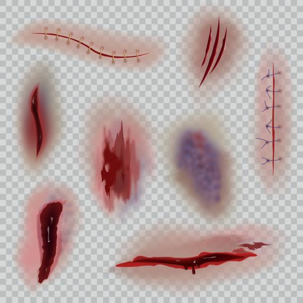 ilustrações de stock, clip art, desenhos animados e ícones de realistic wounds. scars, surgical stitches and bruise, skin incision. bloody wound halloween close-up textures vector isolated set - wound blood human finger human hand
