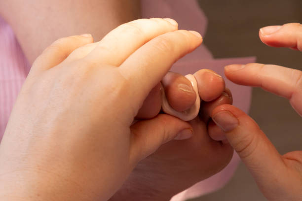 traitement avec orthèse en silicone sur un pied - orthèse photos et images de collection